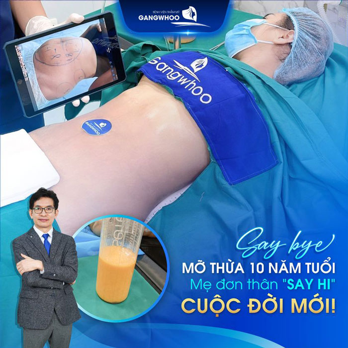 Hút Mỡ Bắp Tay Chẳng Ngại Ngần Thả Dáng Năm 2023