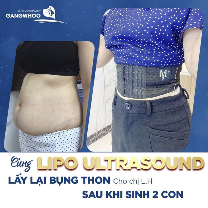 Hút Mỡ Bắp Tay Chẳng Ngại Ngần Thả Dáng Năm 2023