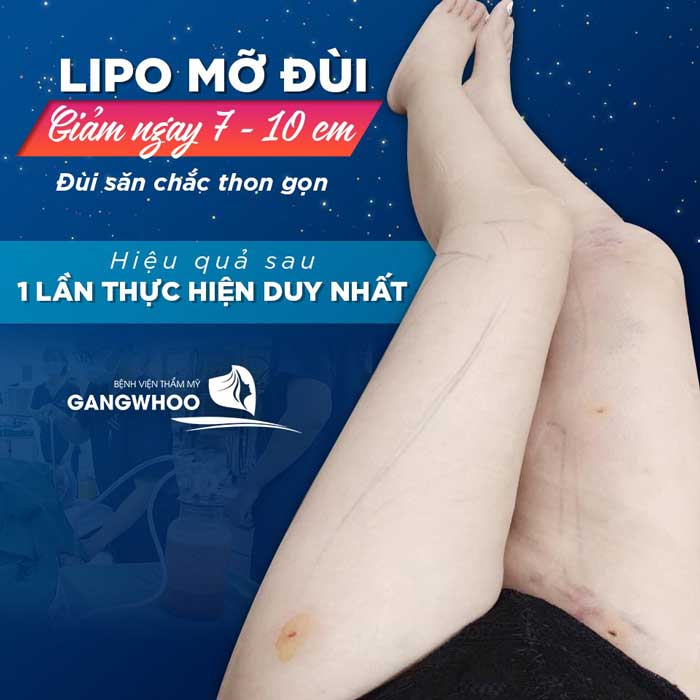 Hút Mỡ Bắp Chân Lipo Ultrasound - Giúp Cho Đôi Chân Thon Gọn