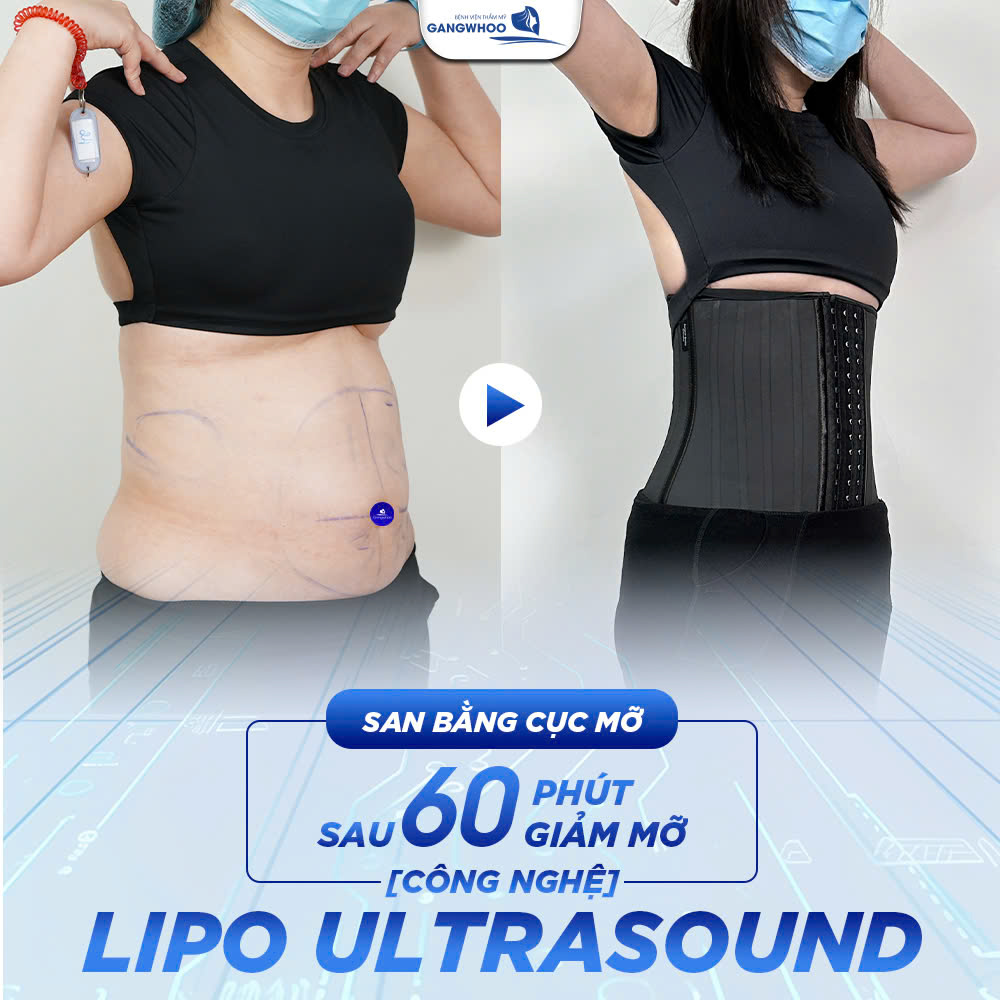 Chỉ với 60 phút giảm mỡ bằng công nghệ Lipo Ultrasound khách hàng đã nhận được kết quả như mong muốn