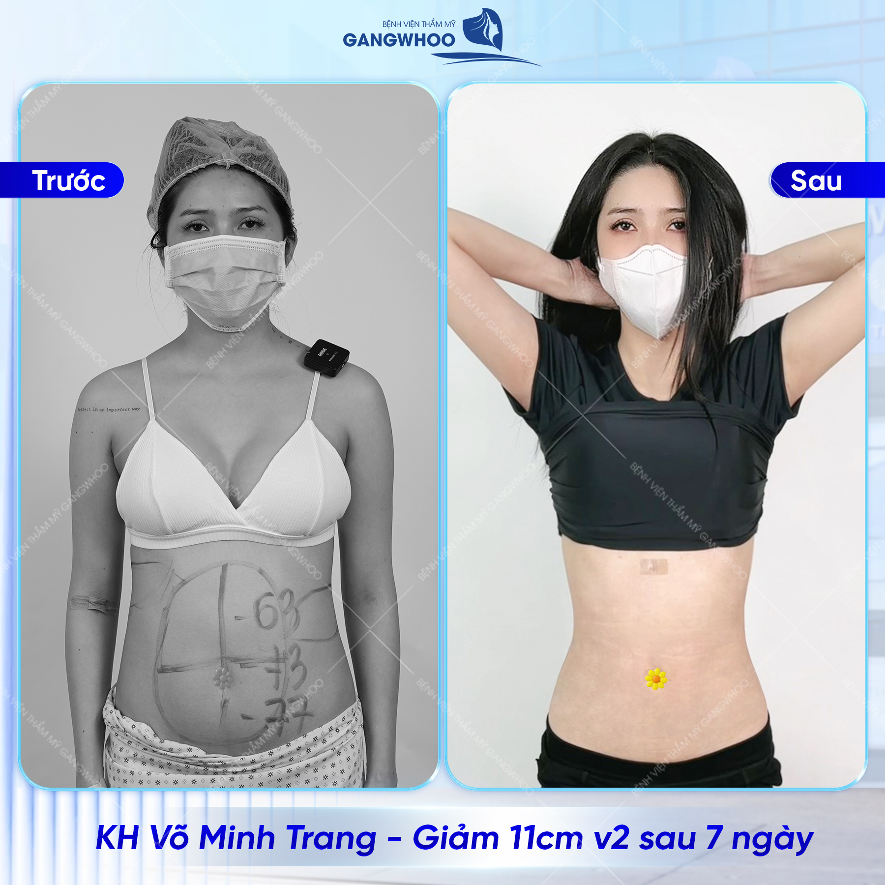 Bác sĩ sẽ thăm khám và đo vẽ vùng cần thực hiện hút mỡ