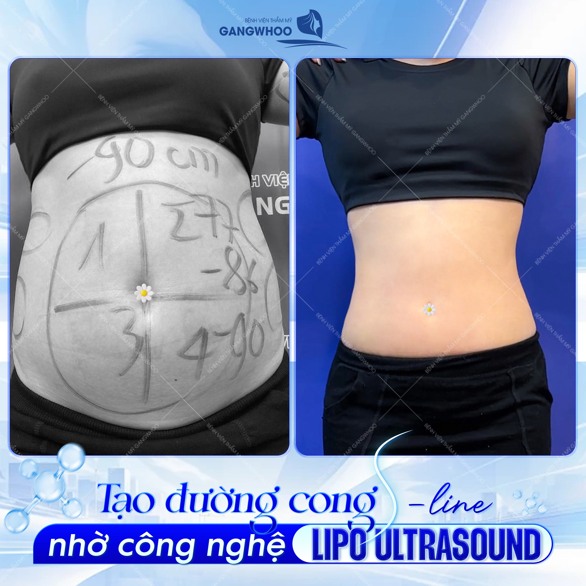 Đường cong hoàn hảo sau khi hút mỡ tại Gangwhoo