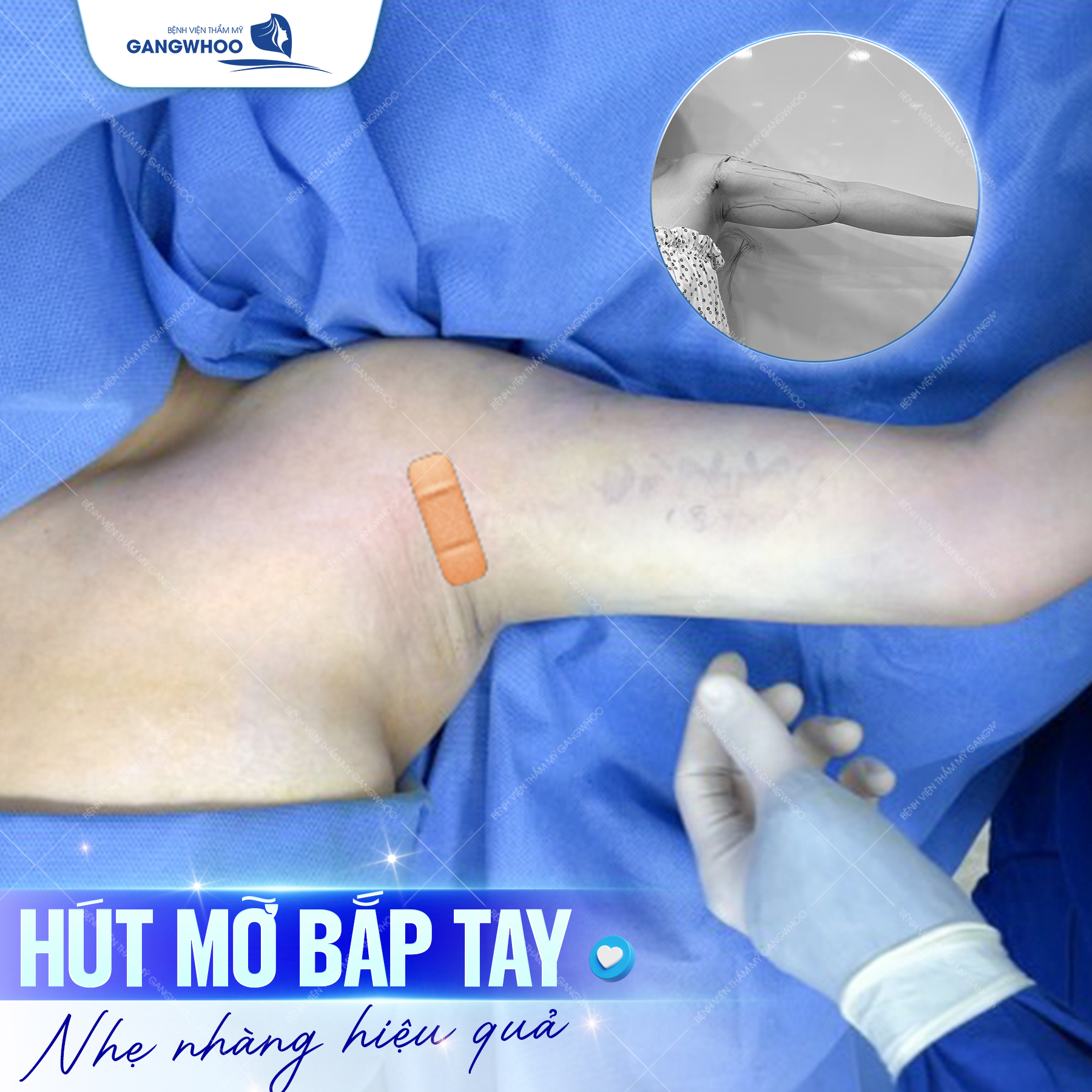 Hút mỡ bắp tay nhẹ nhàng hiệu quả