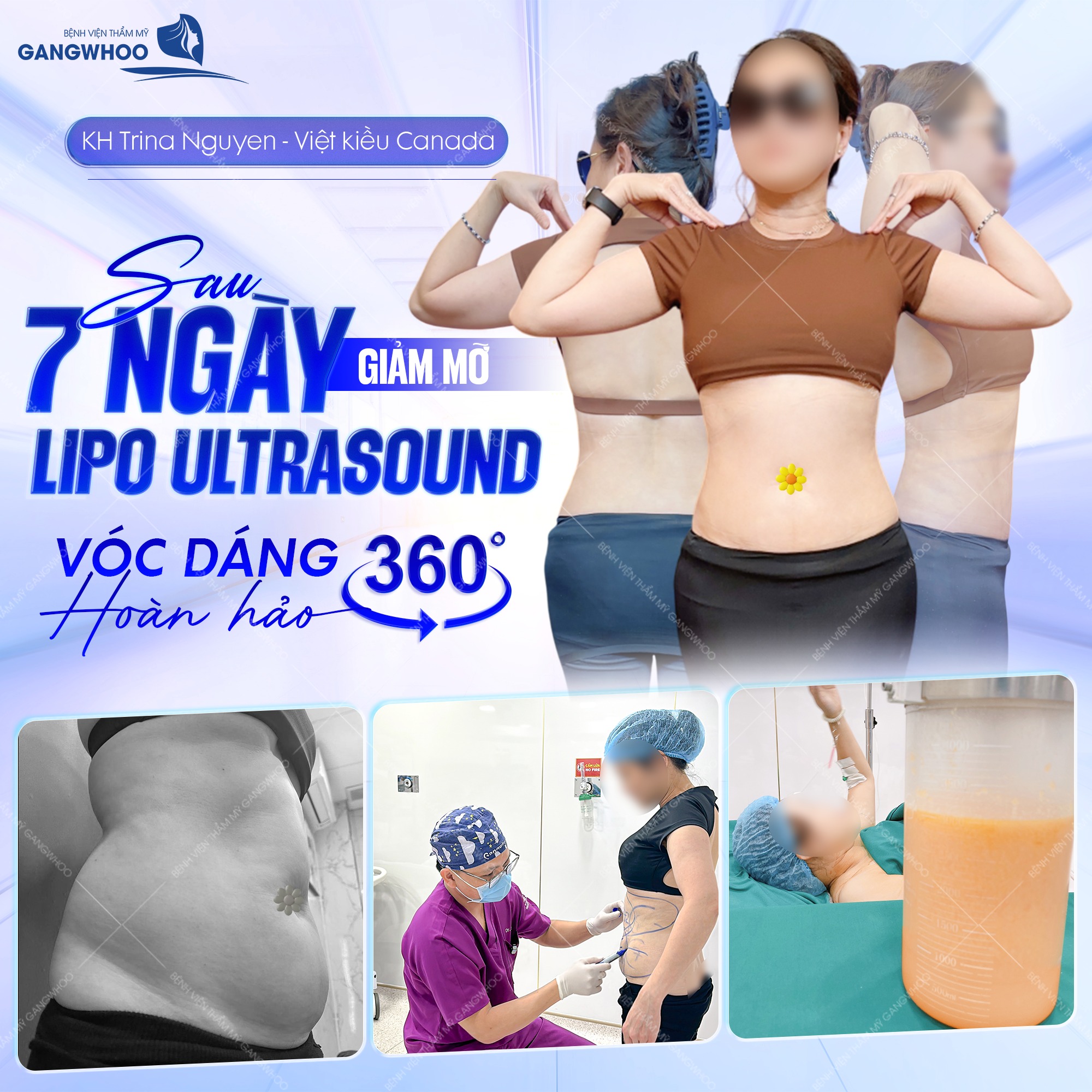 Công nghệ hút mỡ Lipo Ultrasound tại BVTM Gangwhoo