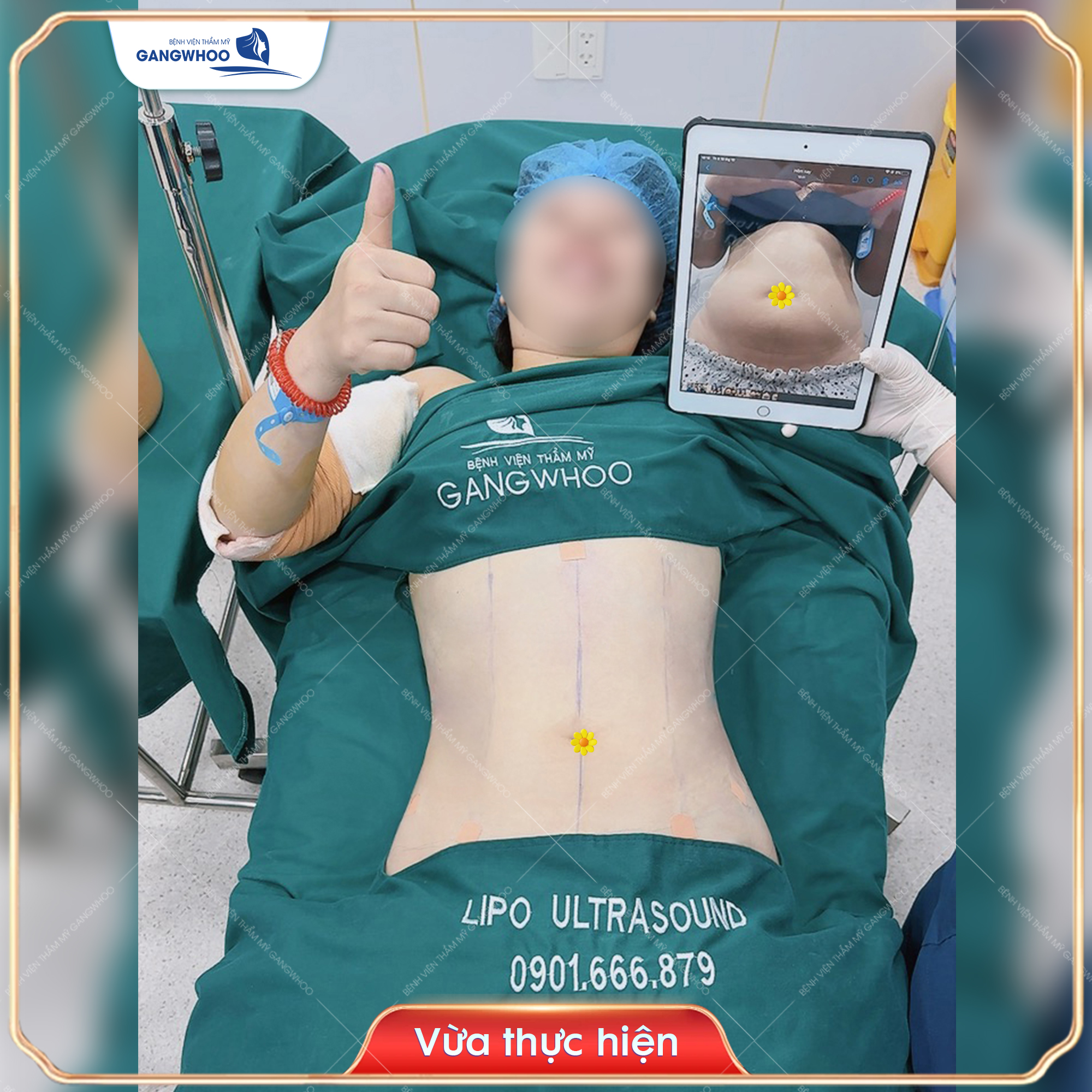 Vòng eo của khách trước và sau khi hút mỡ tại Gangwhoo