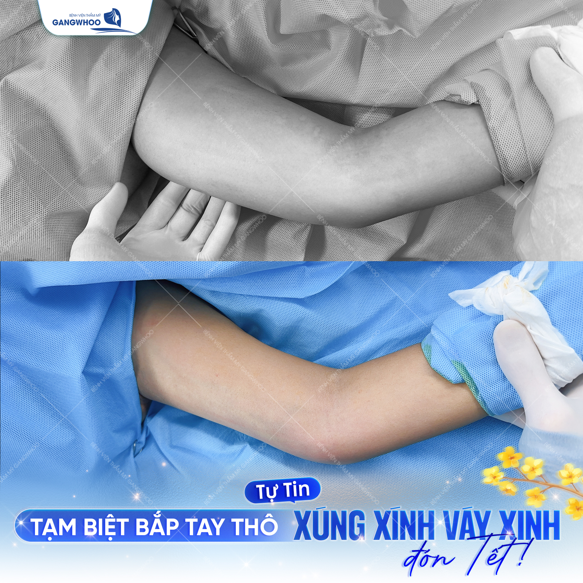Mỡ ở cánh tay cũng là nỗi lo lắng của nhiều chị em phụ nữ, nhưng với công nghệ tại Gangwhoo có thể xử lý được hết tất cả