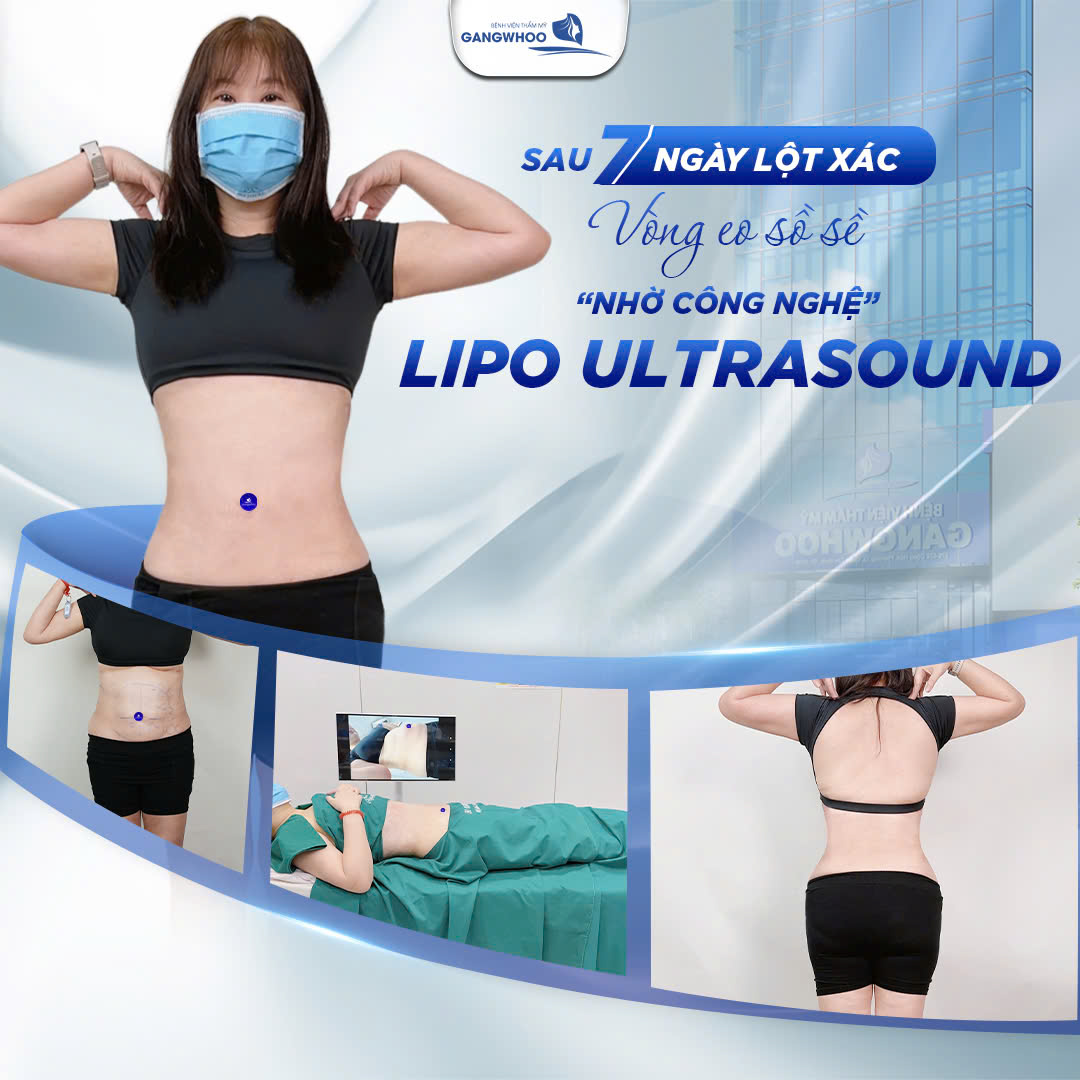 7 ngày đánh bay vòng eo sồ sề nhờ công nghệ Lipo Ultrasound
