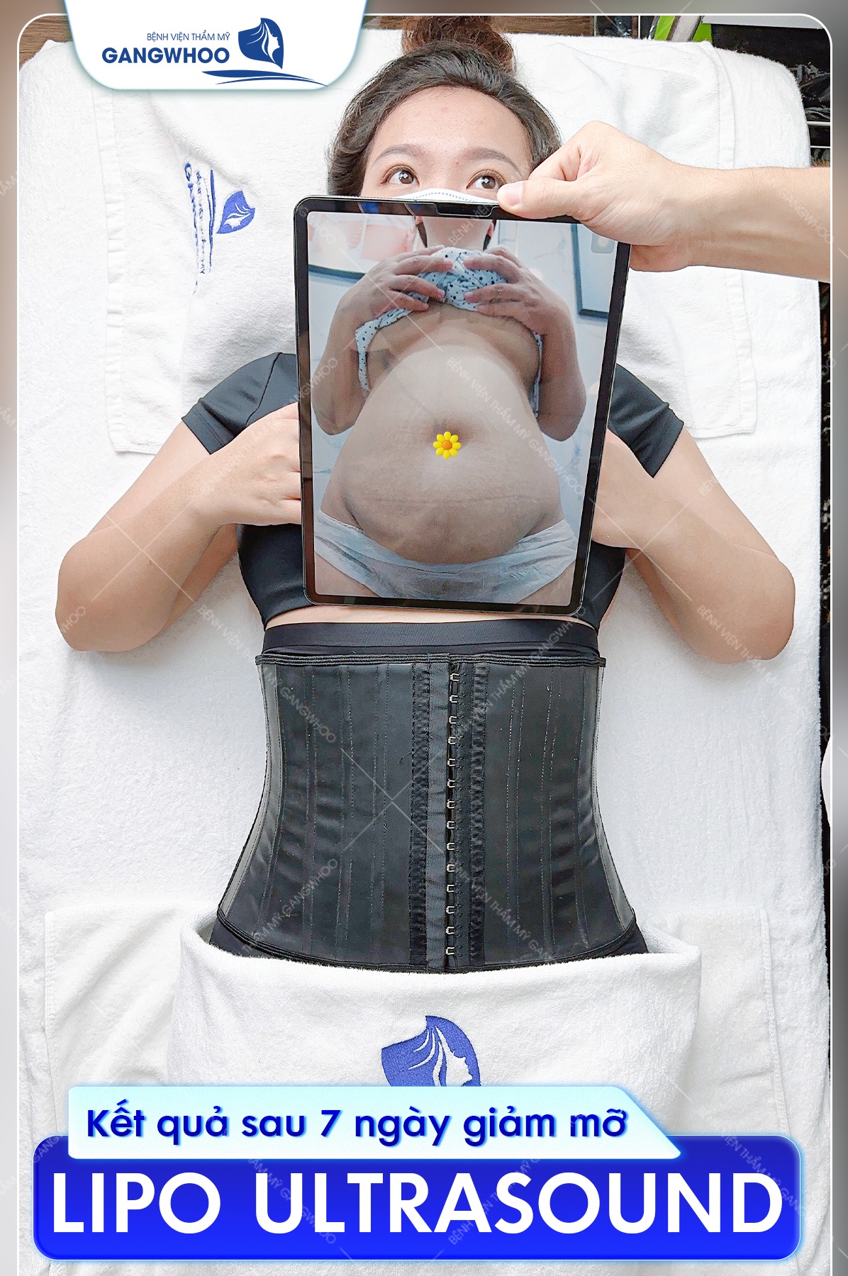 Ảnh khách hàng trước và sau khi hút mỡ bằng công nghệ Lipo Ultrasound